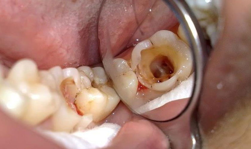 Hậu quả của việc điều trị tủy răng thất bại