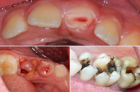 Tăng nguy cơ mắc các bệnh lý răng miệng