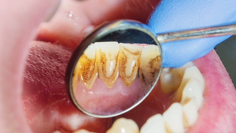 Gãy răng hàm do vệ sinh răng miệng kém