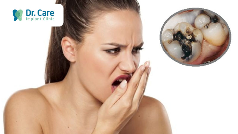 Tại sao sâu răng lại gây hôi miệng?