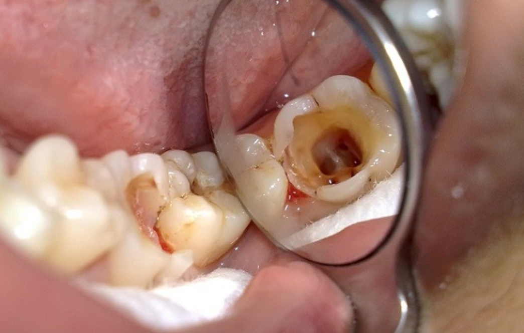 Nguy cơ biến chứng các bệnh về răng miệng