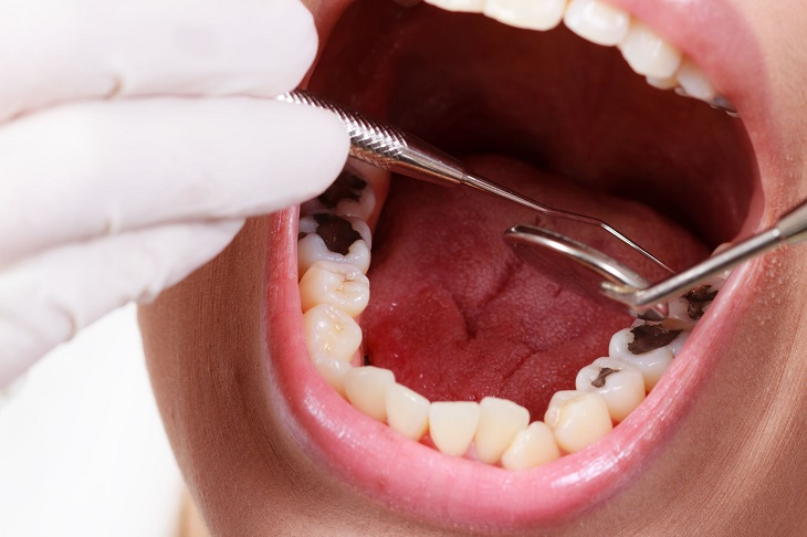 Thăm khám và điều trị dứt điểm sâu răng, hôi miệng tại Nha khoa