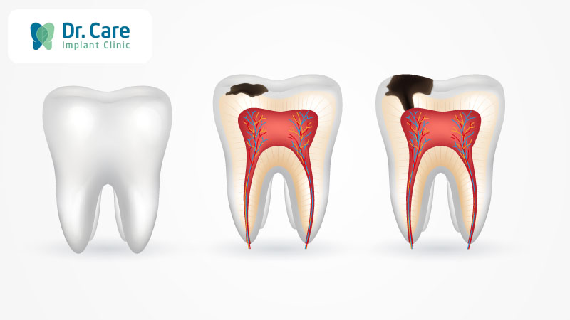 Tìm hiểu sâu răng là gì?
