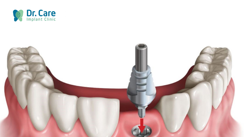 Người cao huyết áp cần lưu ý gì để trồng răng Implant an toàn?