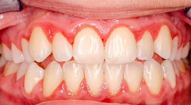 Nướu răng chưa kịp thích nghi với răng giả