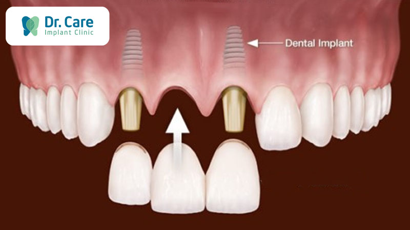 Mất 3 răng liền kề nên trồng mấy trụ Implant?