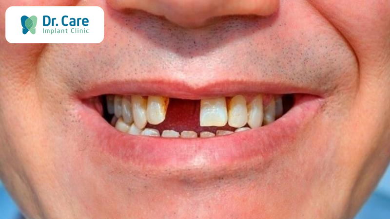 Mất răng ảnh hưởng đến sức khỏe như thế nào?
