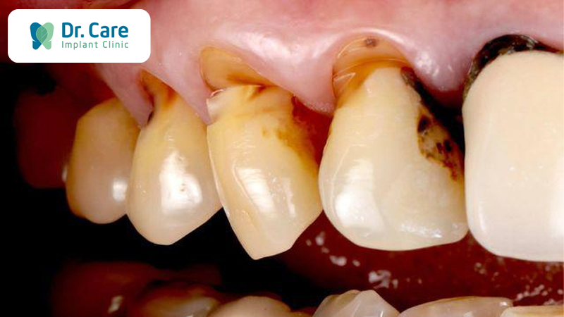 Mất răng do mắc các bệnh về răng miệng