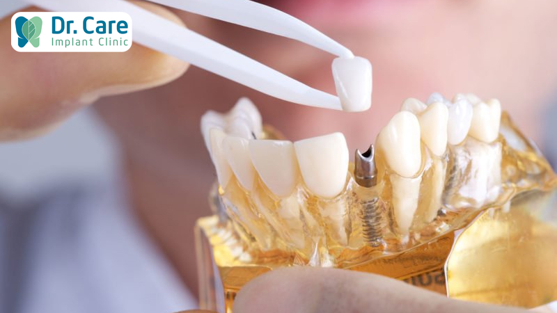 Trồng răng Implant nên sử dụng răng sứ hay răng nhựa Composite?