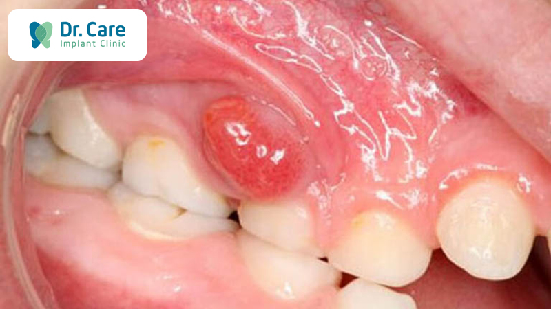 Nhiễm khuẩn răng miệng là gì? Nguyên nhân do đâu? 