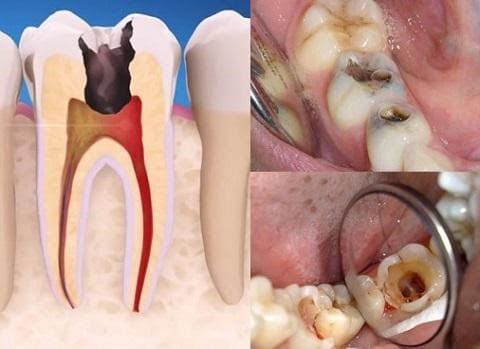 Nhiễm khuẩn gây mất răng vĩnh viễn