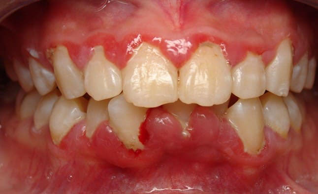 Bị sưng đau, phù nề vùng nướu răng và hàm mặt