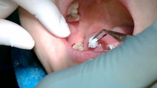 Nhổ răng là gì? Những trường hợp nào cần nhổ răng
