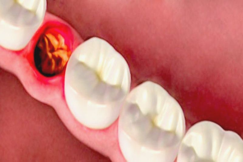 Viêm xương ổ răng sau nhổ răng
