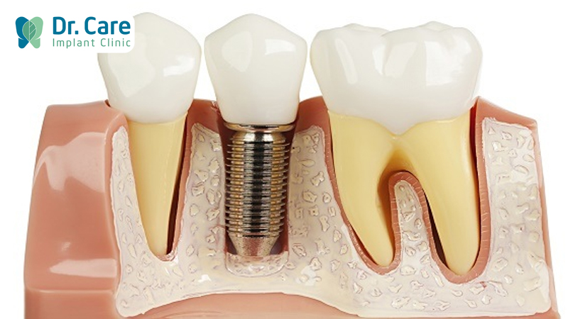 Trồng răng Implant ngăn chặn hôi miệng hiệu quả