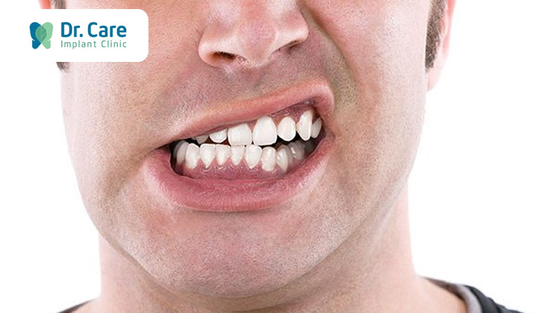Tật nghiến răng và niềng răng