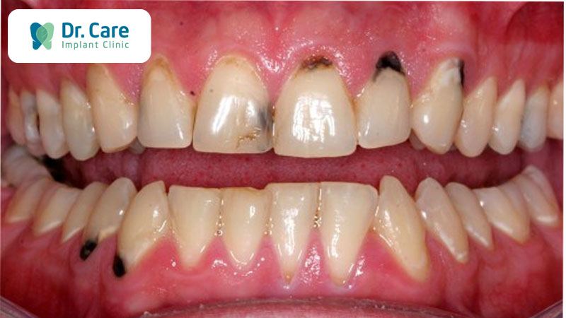 Răng xuất hiện đốm đen, vết đen giữa kẽ răng là gì?