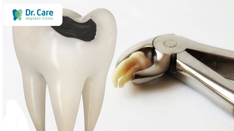 Điều trị nội nha nếu răng khôn mọc thẳng, muốn bảo tồn răng
