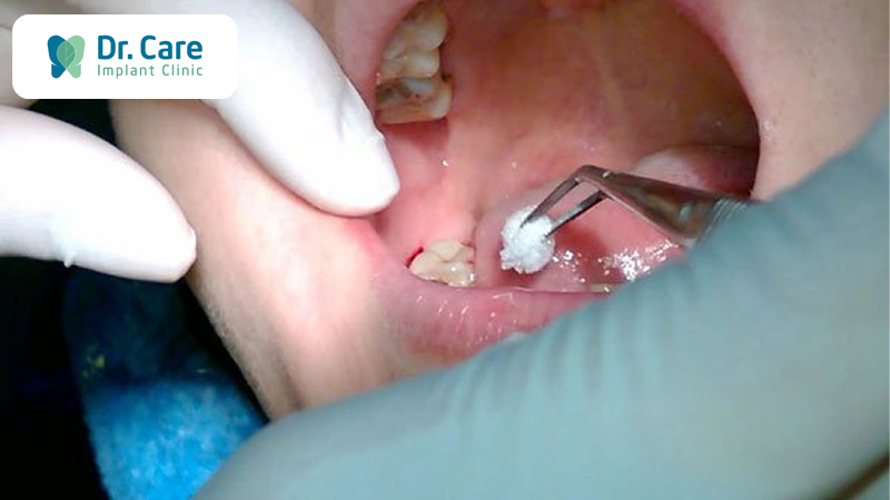 Xử lý răng khôn bị sâu bằng cách nào? Có nên nhổ bỏ răng khôn?