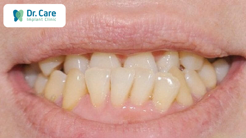 Đối với răng cửa và các răng hàm nhai bị mọc lệch vào trong