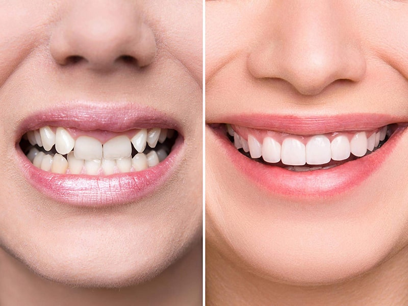 Bọc răng sứ đối với răng mọc lệch vào trong mức độ nhẹ