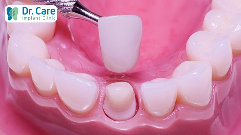 Răng sứ là gì? Trường hợp nào nên bọc răng sứ