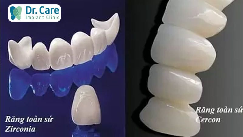 Nên phục hình bằng răng toàn sứ Zirconia hay Cercon?