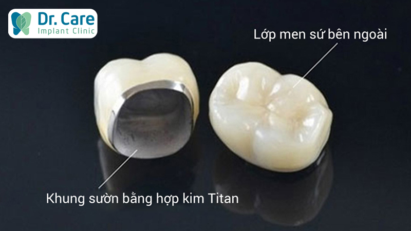 Răng sứ Titan là gì? Ưu và nhược điểm