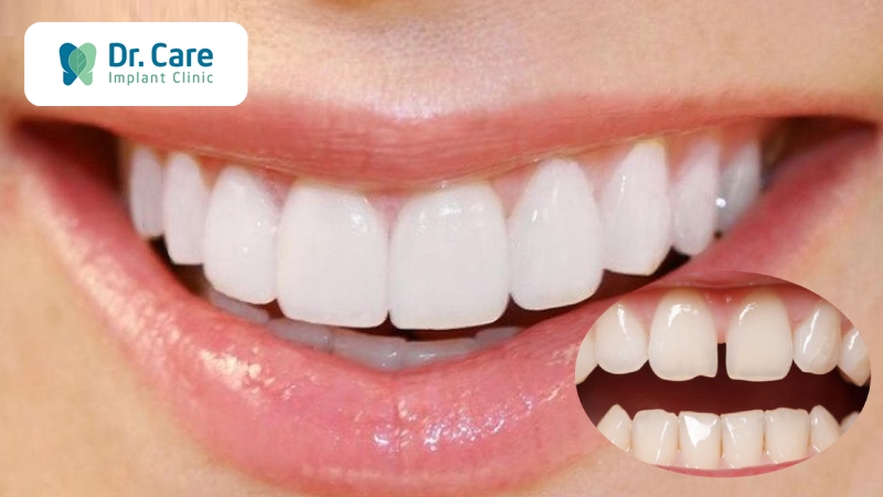 4 phương pháp chữa trị thưa răng hiệu quả, an toàn