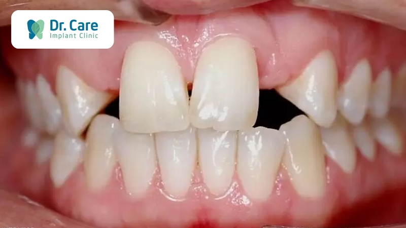 Răng thưa, có khoảng cách lớn do mất răng chậm trồng lại răng mới 