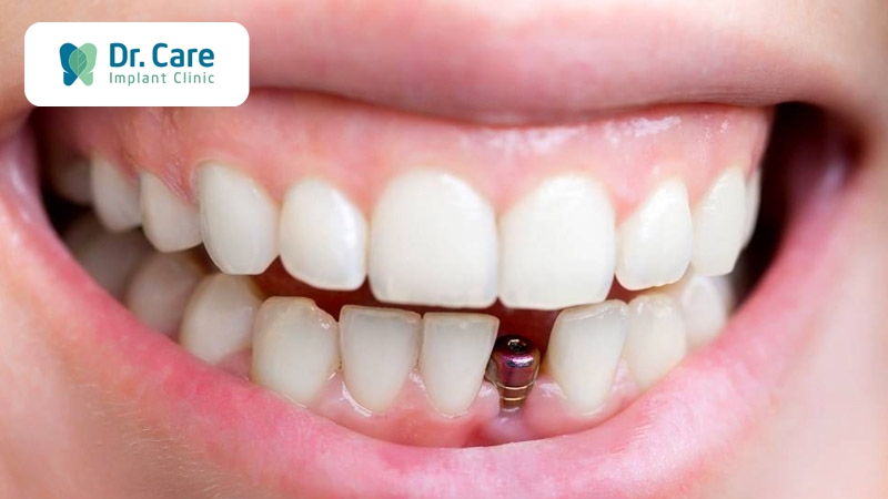 Trồng răng Implant cho khoảng răng thưa lớn do mất răng