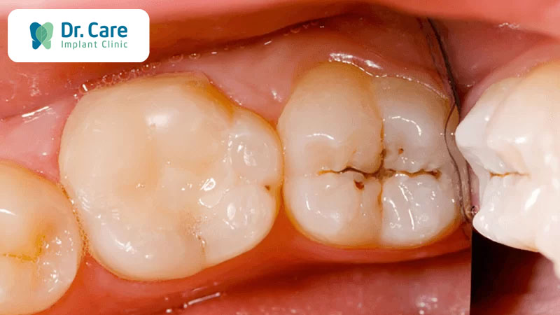 Triệu chứng sâu răng hàm dễ nhận biết
