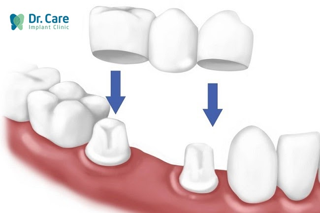 Trường hợp làm cầu răng sứ phục hình răng hàm