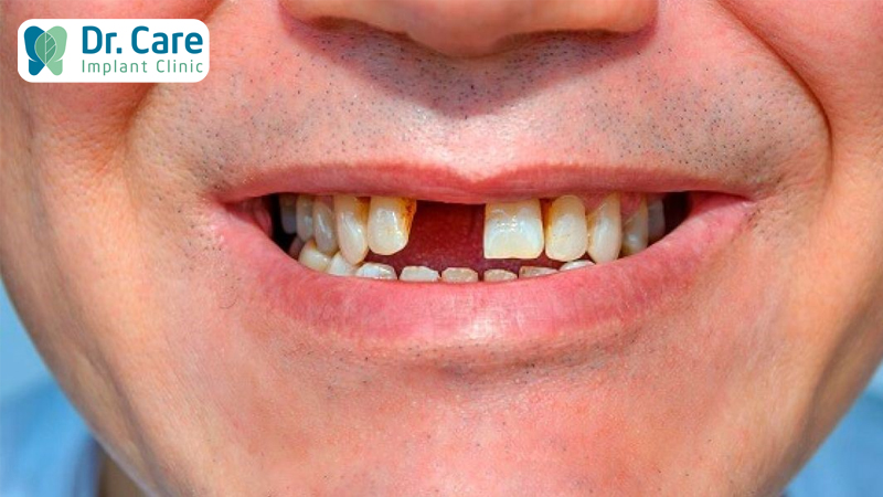 Trường hợp nào nên thay thế răng thật bằng răng sứ?