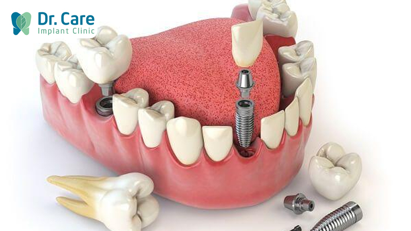 Trồng răng Implant nên chọn răng nào?
