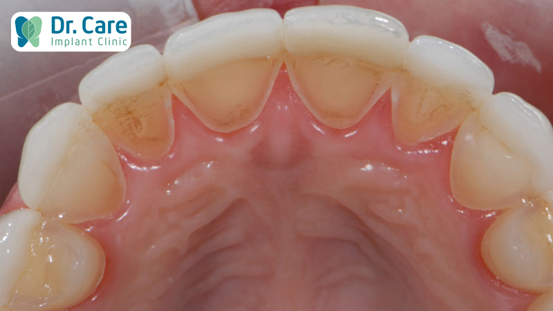 Chẩn đoán bệnh lý răng miệng do trào ngược dạ dày
