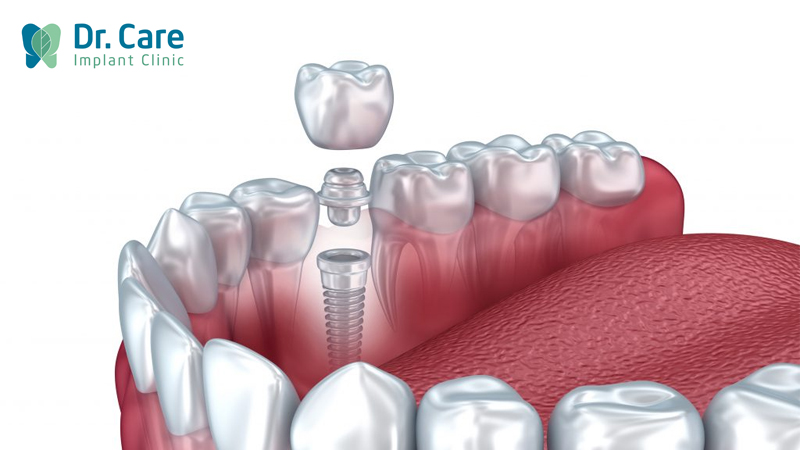 Trồng răng giả là gì? 2 Phương pháp trồng răng giả cố định hiện nay