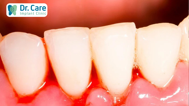 Điều trị khỏi viêm nướu trước khi trồng răng Implant