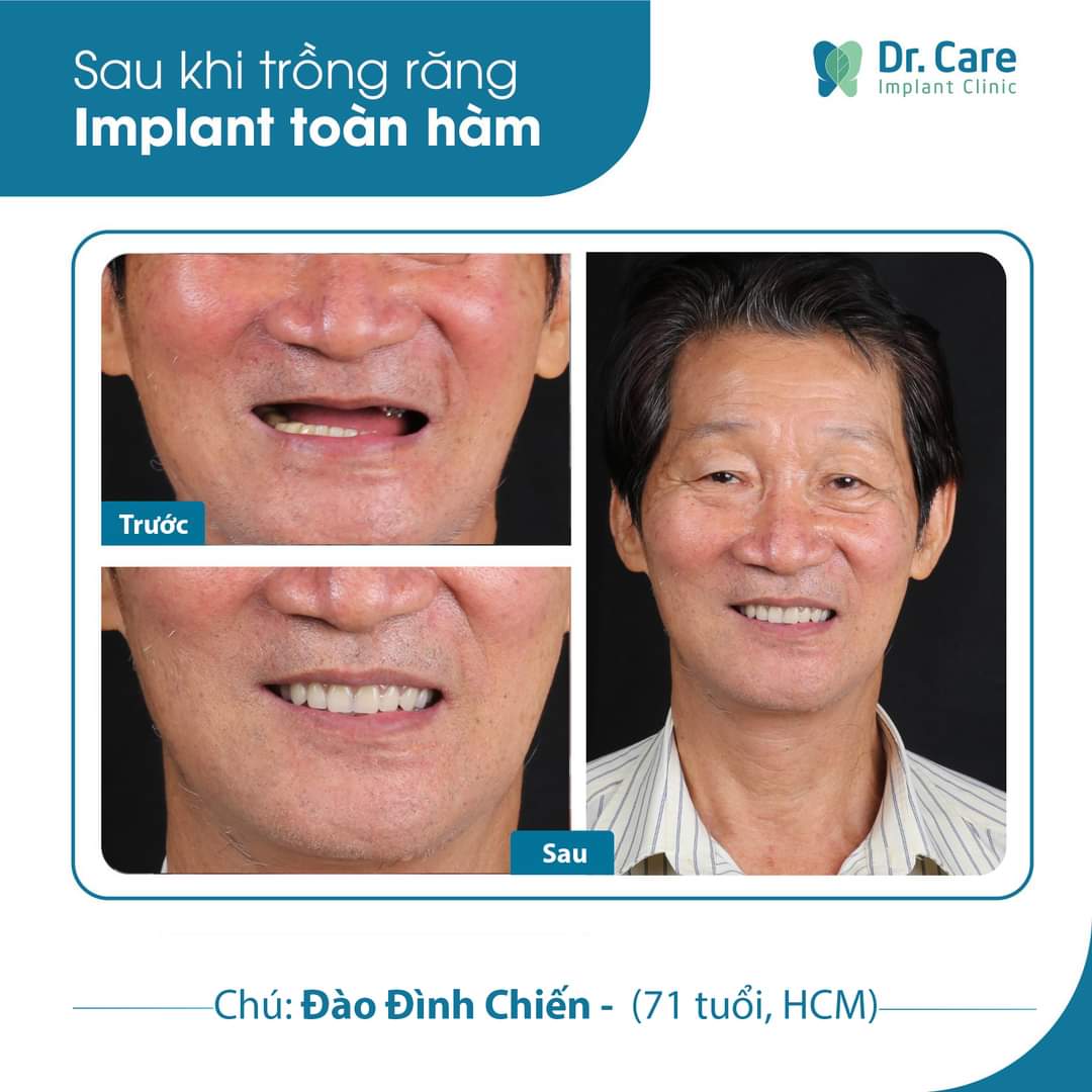 Trồng răng Implant hàm trên không đau tại Dr.Care - Implant Clinic