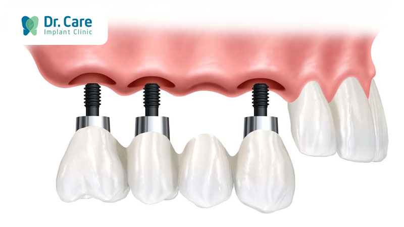 Kết hợp làm cầu răng trên Implant để tiết kiệm