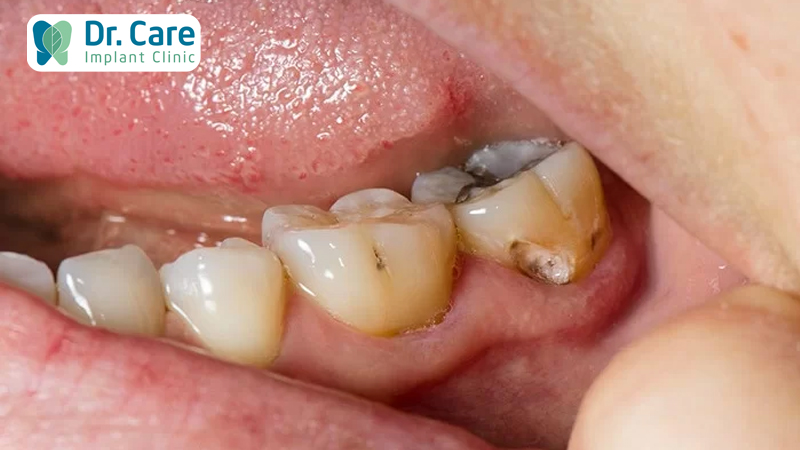 Sâu răng cần được điều trị trước khi cấy ghép Implant