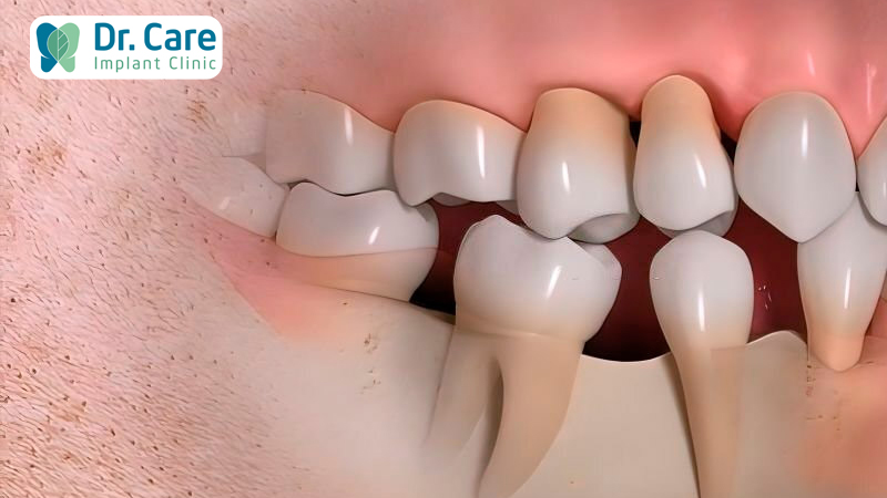Mất răng lâu năm khiến răng trên hàm xô lệch, tiêu xương