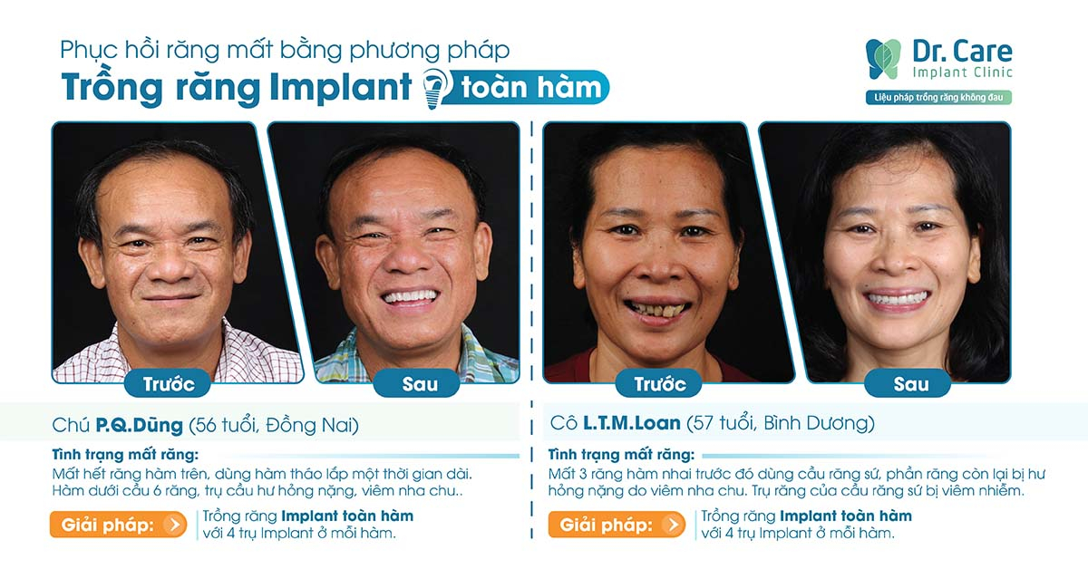 Trồng trụ Implant Hàn Quốc khôi sau khi tháo răng cũ