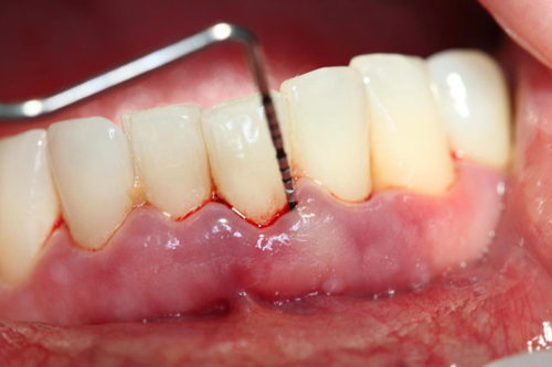 Phương pháp điều trị viêm chân răng có mủ hiệu quả