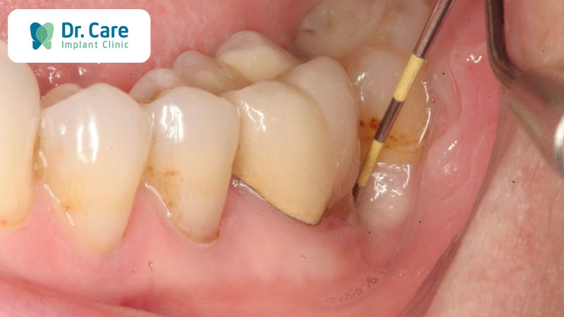Viêm chân răng có mủ là bệnh lý gì?