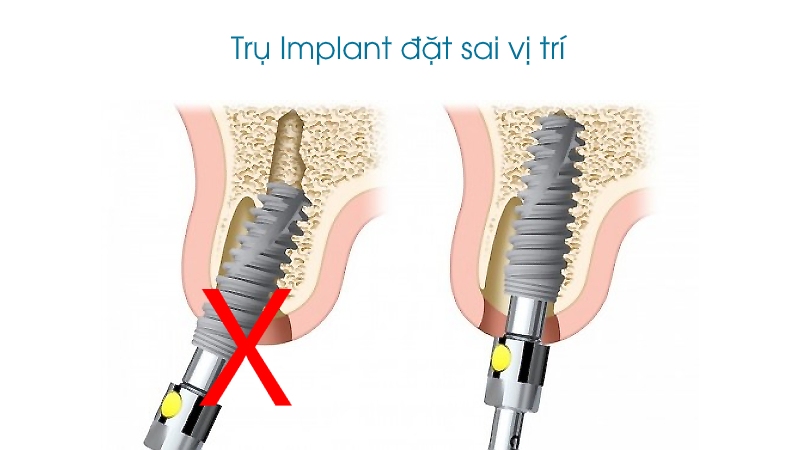 Bác sĩ cấy ghép Implant không đúng cách, đặt sai vị trí