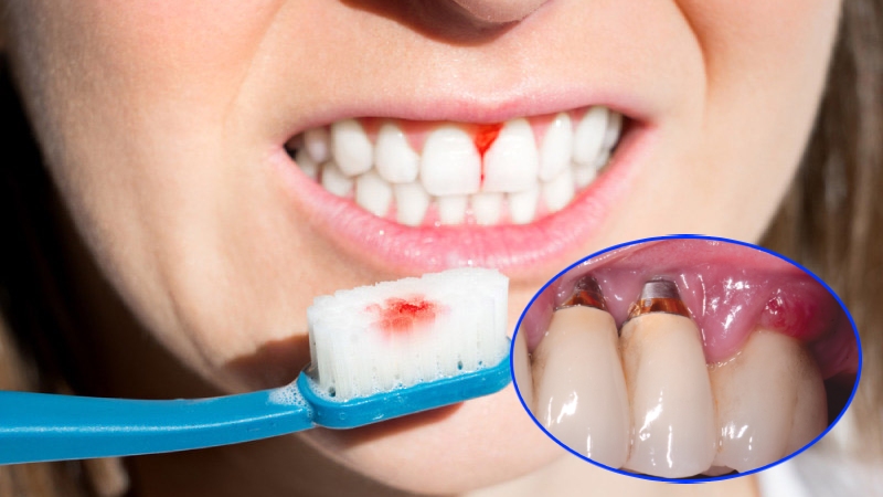 Chưa điều trị triệt để bệnh lý viêm quanh răng trước khi cấy ghép