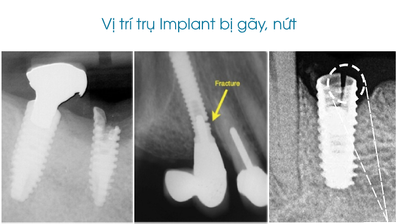 Trụ Implant không phù hợp với kích thước xương hàm và phương pháp phục hồi