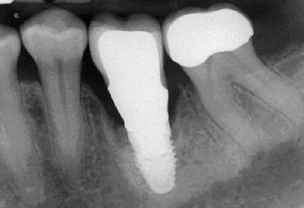 Yếu tố chẩn đoán và quy tắc điều trị viêm quanh răng Implant