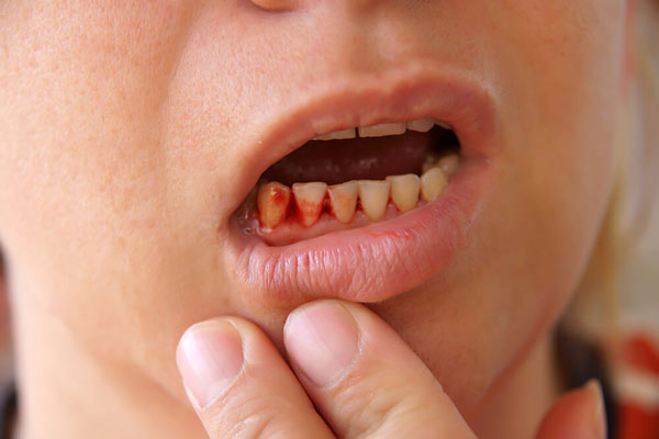 Thiếu vitamin gây chảy máu chân răng